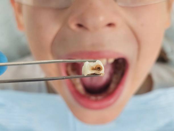 Best Urgent Care for Lost Fillings or Crowns in Coaldale, PA